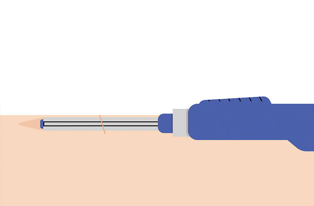 The second step of the Eversense system implantable CGM insertion process. 